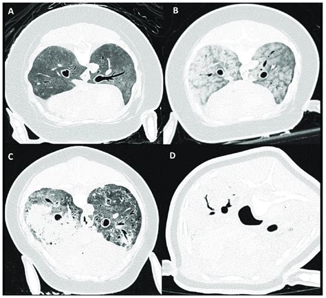 soft tissue attenuation